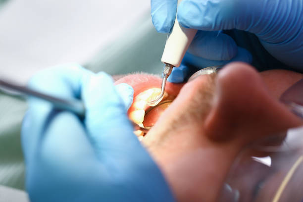 Best Emergency Dental Care for Broken or Chipped Teeth in Bay Springs, MS